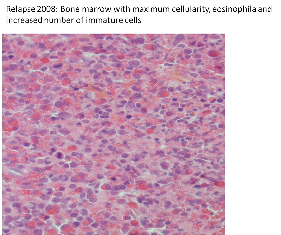 Fig 6. Bone marrow clot at relapse